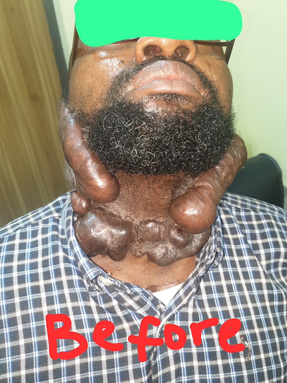 Before: Giant Submandibular and Neck Soft Tissue Tumour